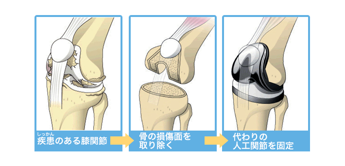 全置換型人工膝関節置換術
