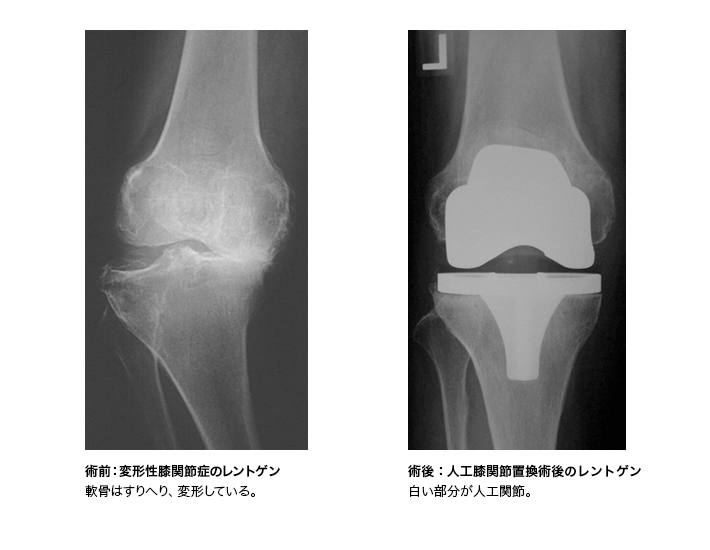 全置換型人工膝関節置換術