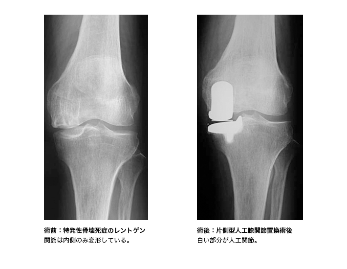 片側型人工膝関節置換術