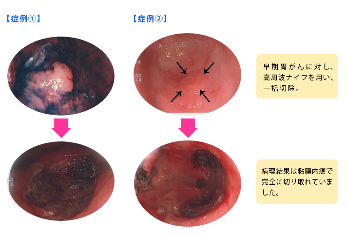 内視鏡で治す（切除する）がん〈ESD：内視鏡的粘膜下層剥離術〉
